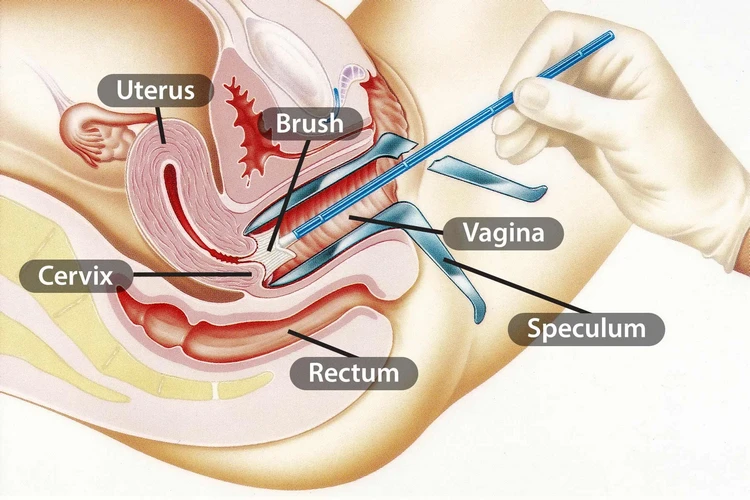 Xét nghiệm Pap: Những điều cần lưu ý