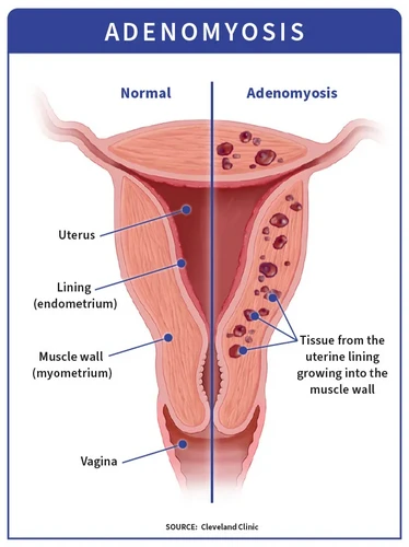 Adenomyosis là gì?