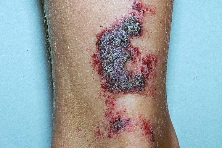 Angiokeratoma là gì?