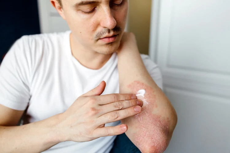 Điều trị tại chỗ cho bệnh vẩy nến