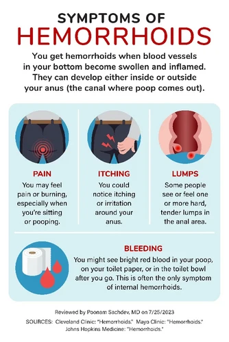 Bệnh trĩ: Triệu chứng, Nguyên nhân và Điều trị