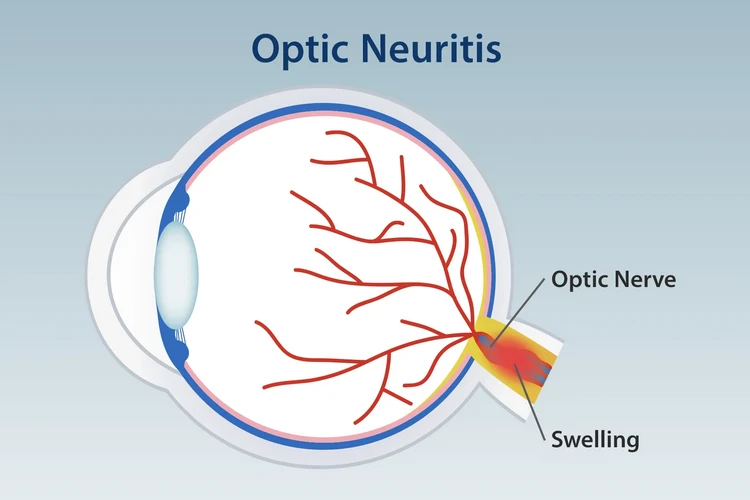 Viêm dây thần kinh thị giác: Khi MS ảnh hưởng đến thị lực của bạn