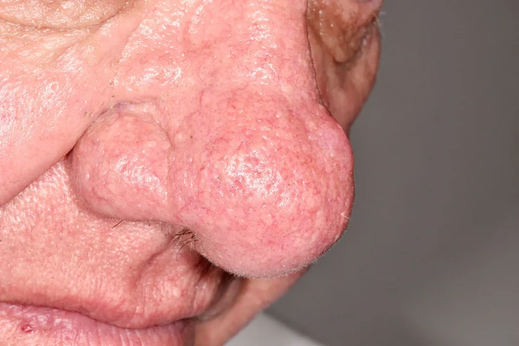 Bệnh Rhinophyma ảnh hưởng đến mũi của bạn như thế nào