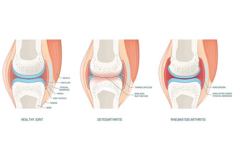 Viêm khớp dạng thấp và viêm xương khớp: Sự khác biệt là gì?