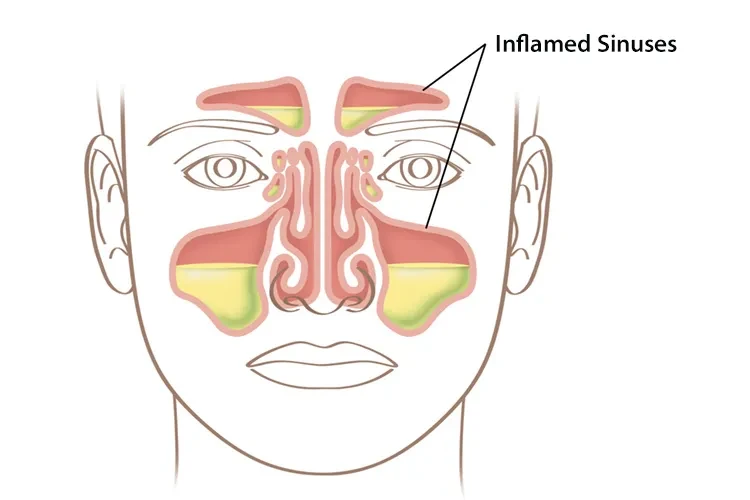 Cách điều trị nghẹt mũi và áp lực xoang