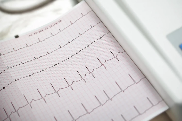 Rung nhĩ (AFib): Triệu chứng và cách điều trị