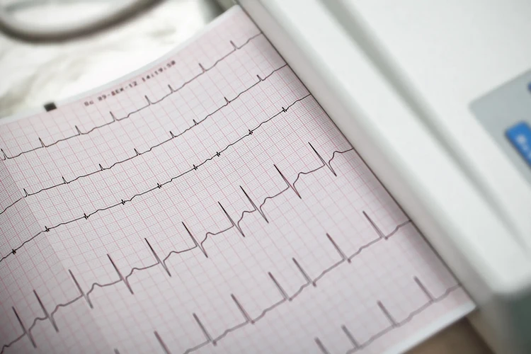 Rung nhĩ (AFib) và nhịp xoang bình thường: Chúng có liên quan với nhau không?