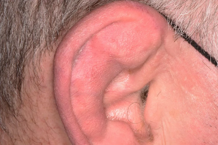 Tai súp lơ: Nguyên nhân, triệu chứng và cách điều trị