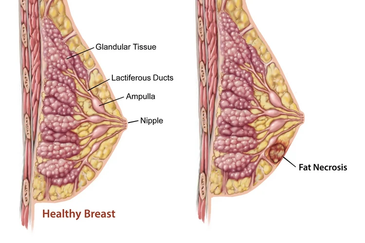 Hoại tử mỡ ngực là gì?