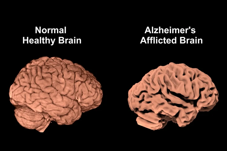 Các yếu tố nguy cơ gây bệnh Alzheimer