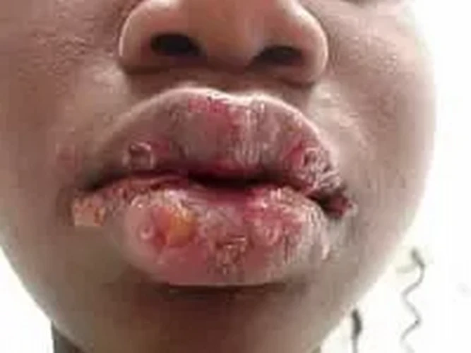 Herpes miệng: Nguyên nhân, triệu chứng và cách điều trị