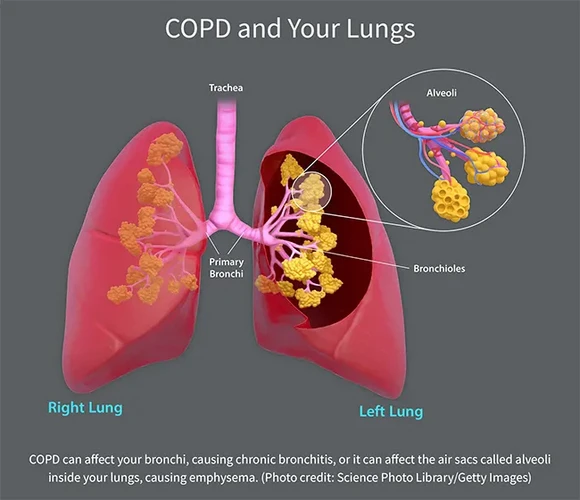 COPD (Bệnh phổi tắc nghẽn mãn tính)