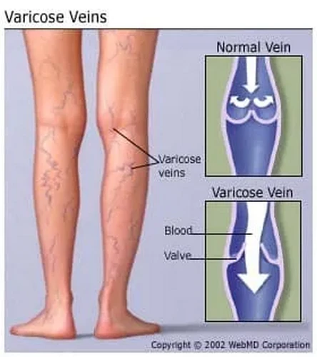 Hiểu về bệnh giãn tĩnh mạch: Những điều cơ bản