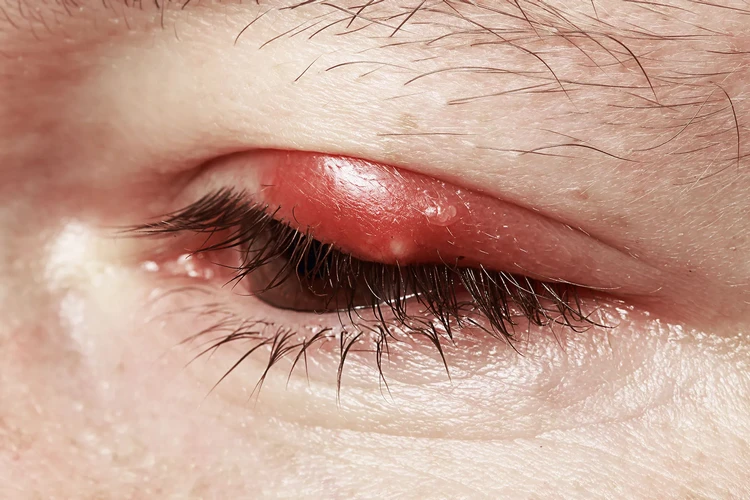 Chalazion: Nguyên nhân, triệu chứng và điều trị