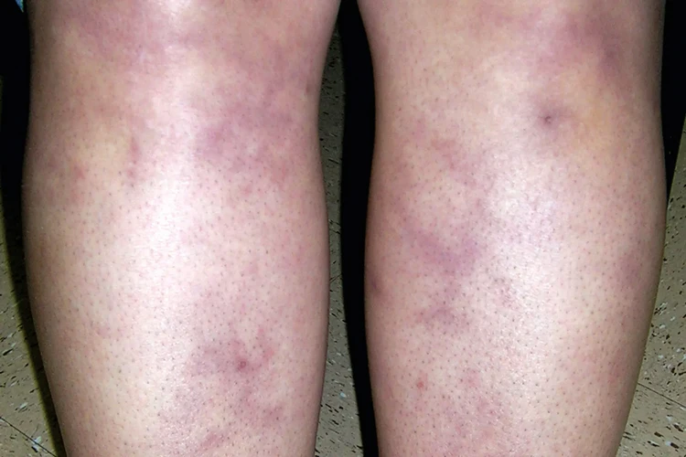 Livedo Reticularis (Da cẩm thạch) là gì?
