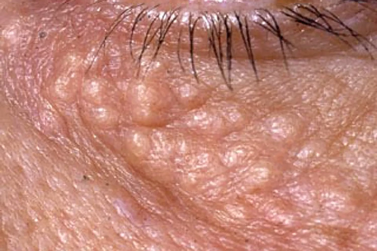 Syringoma: Nguyên nhân, triệu chứng và điều trị