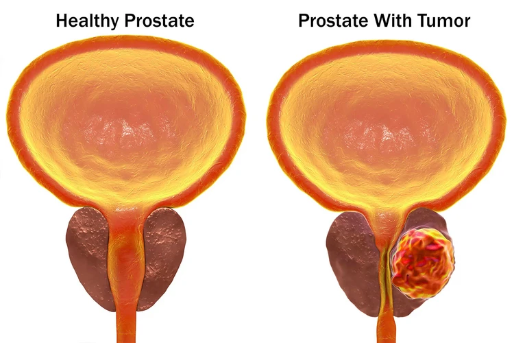 Nguyên nhân gây ung thư tuyến tiền liệt: Những điều cần biết