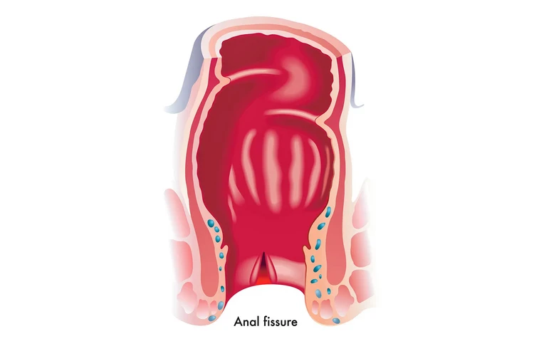 Nứt hậu môn