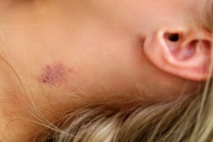 Hickeys
