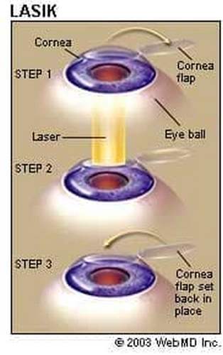 Phẫu thuật mắt LASIK