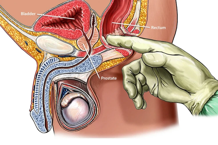 Khám ung thư tuyến tiền liệt