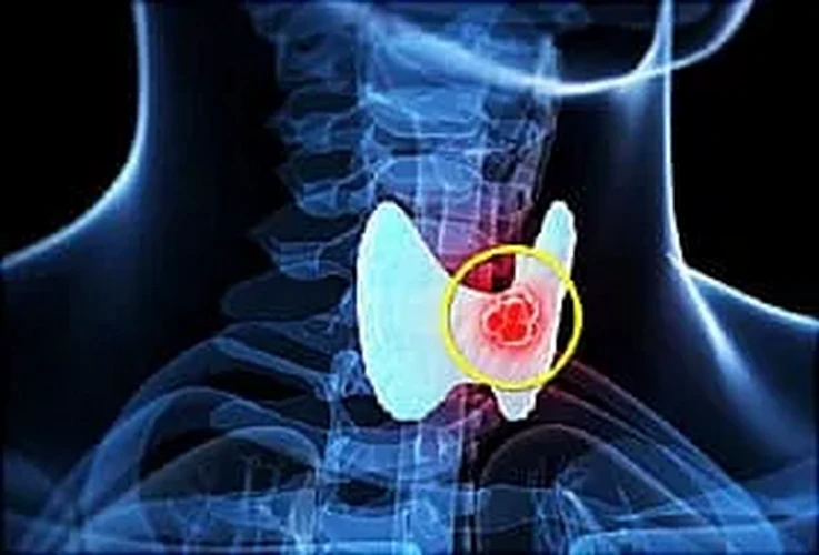 Ung thư tuyến giáp dạng nhú là gì?