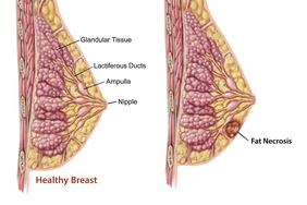 Hoại tử mỡ ngực là gì?