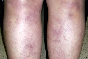 Livedo Reticularis (Da cẩm thạch) là gì?