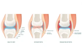 Viêm khớp dạng thấp và viêm xương khớp: Sự khác biệt là gì?