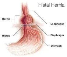 Mẹo ăn kiêng cho bệnh thoát vị khe hoành