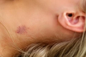 Hickeys