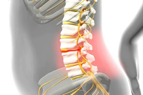 Thoát vị đĩa đệm: Triệu chứng và chẩn đoán