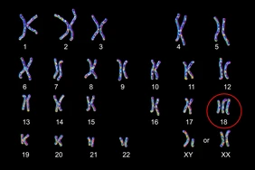 Hội chứng Trisomy 18 là gì?