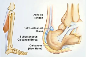 Chấn thương gân Achilles là gì?