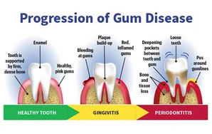 Viêm nướu và bệnh nha chu (bệnh nướu răng)