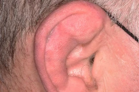Tai súp lơ: Nguyên nhân, triệu chứng và cách điều trị