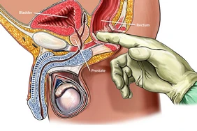 Khám ung thư tuyến tiền liệt