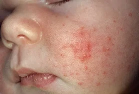 Mụn trứng cá ở trẻ sơ sinh