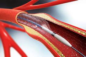 Stent là gì?