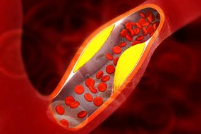 11 Mẹo Giảm Cholesterol Nhanh Chóng
