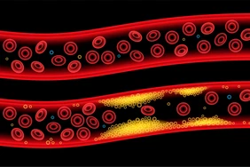 Các bệnh liên quan đến Cholesterol cao