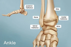 Chấn thương mắt cá chân: Nguyên nhân, cách điều trị và phòng ngừa