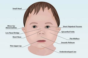 Hội chứng rượu bào thai: Dấu hiệu và triệu chứng