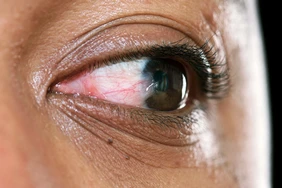 Pterygium (mắt lướt sóng) là gì?