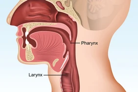 Ung thư vòm họng: Những điều cần biết