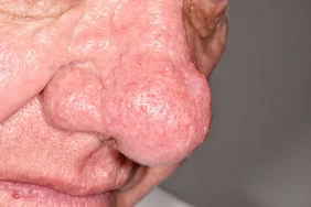 Bệnh Rhinophyma ảnh hưởng đến mũi của bạn như thế nào